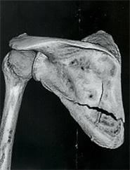 肩甲骨骨折CT画像