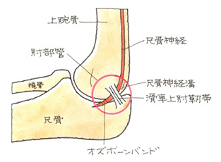 尺骨神経が、肘部管というトンネルの中で絞扼・圧迫されているもの