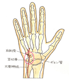 有鈎骨の骨折によるギオン管症候群