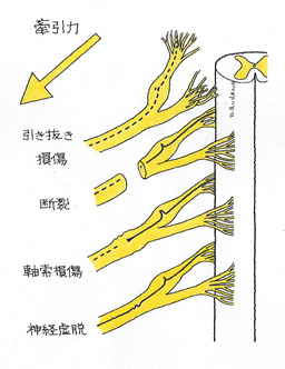 脊髄から神経根が引き抜かれる損傷