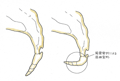 尾骨骨折による屈曲変形