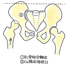 恥骨結合離開と仙腸間接脱臼