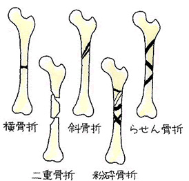 大腿骨骨幹部骨折の種類