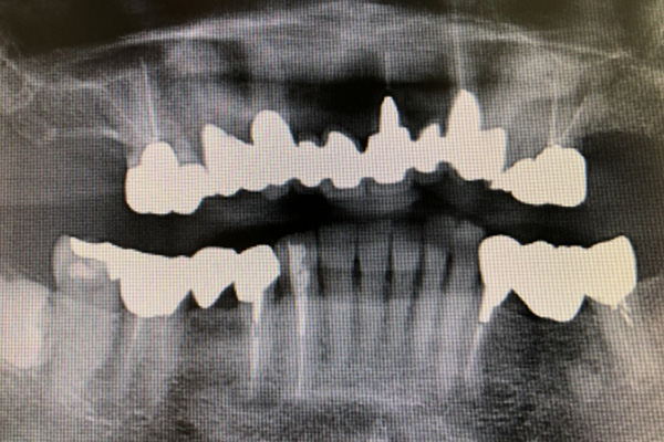 歯の後遺障害
