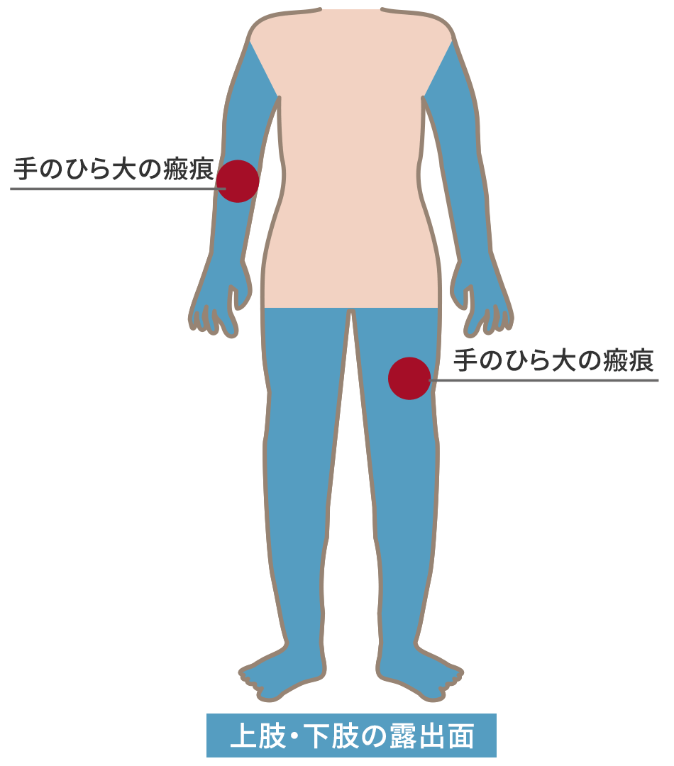 上肢・下肢の露出面の醜状