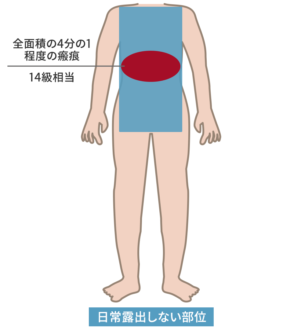 日常露出しない部位の醜状