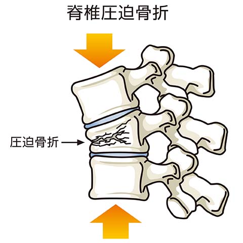 脊椎の圧迫骨折