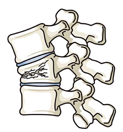 脊椎の破裂骨折