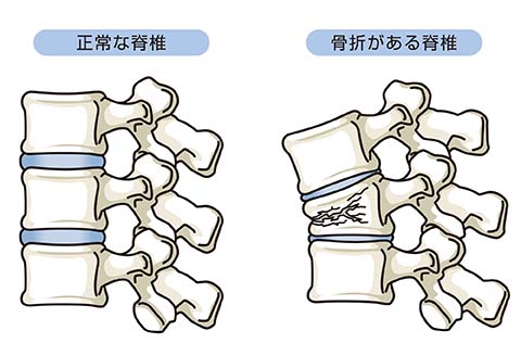 環軸椎脱臼・亜脱臼