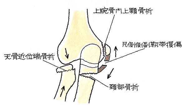 上腕骨内上顆骨折、尺骨近位端骨折、尺側側副靭帯損傷
