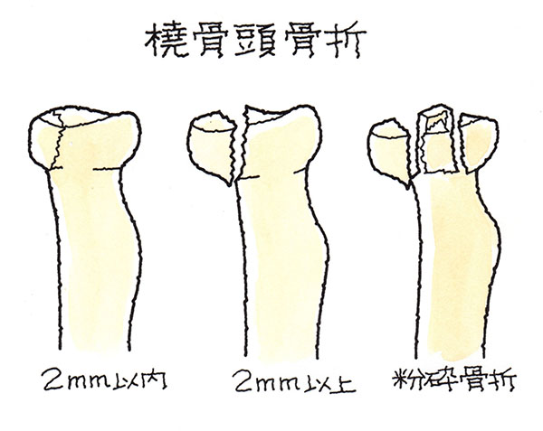 橈骨頭骨折