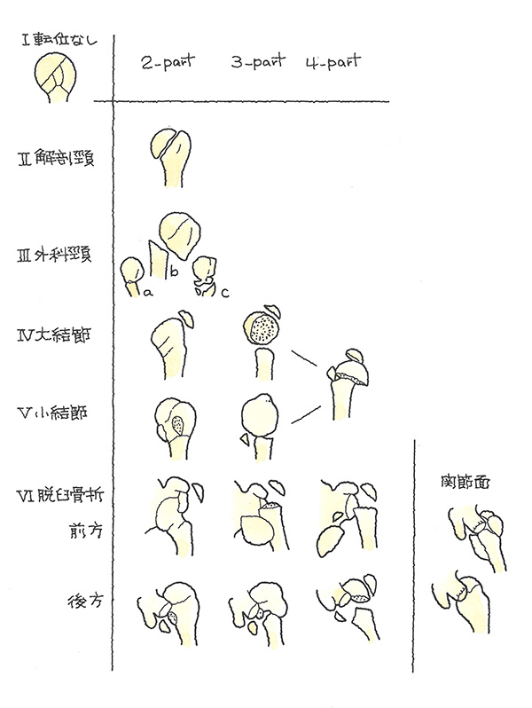 骨折の部位と骨片の数による分類