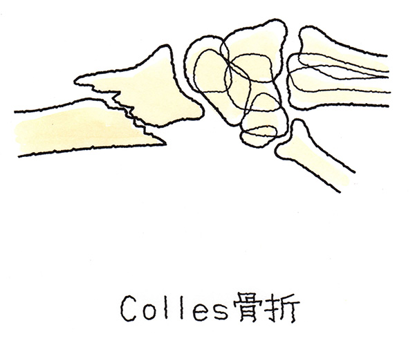 コーレス骨折
