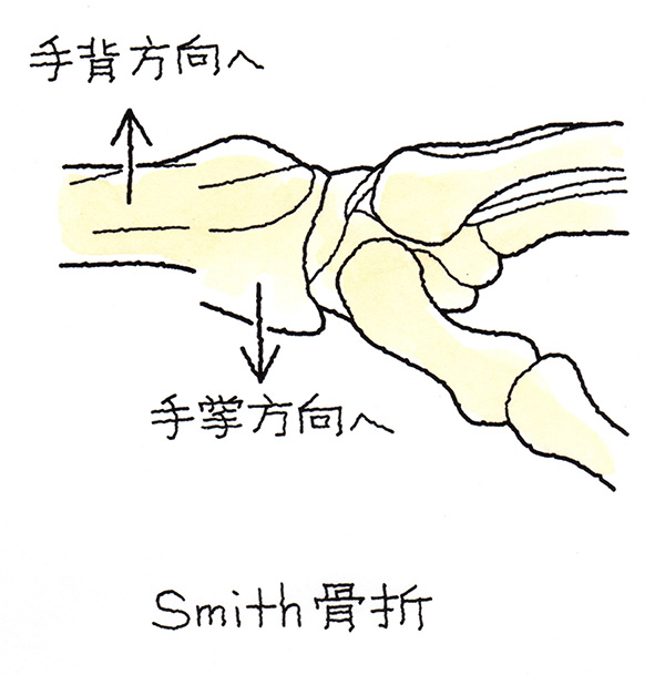スミス骨折