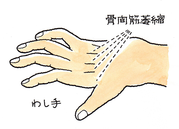 わし手--骨間筋萎縮